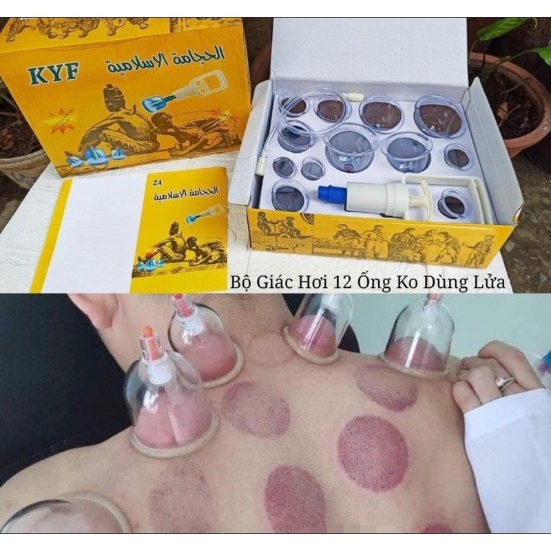 Bộ Gi&aacute;c Hơi 12 Cốc Kh&ocirc;ng D&ugrave;ng Lửa C&oacute; D&acirc;y Nối Hot